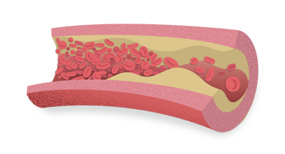 Dislipidemia